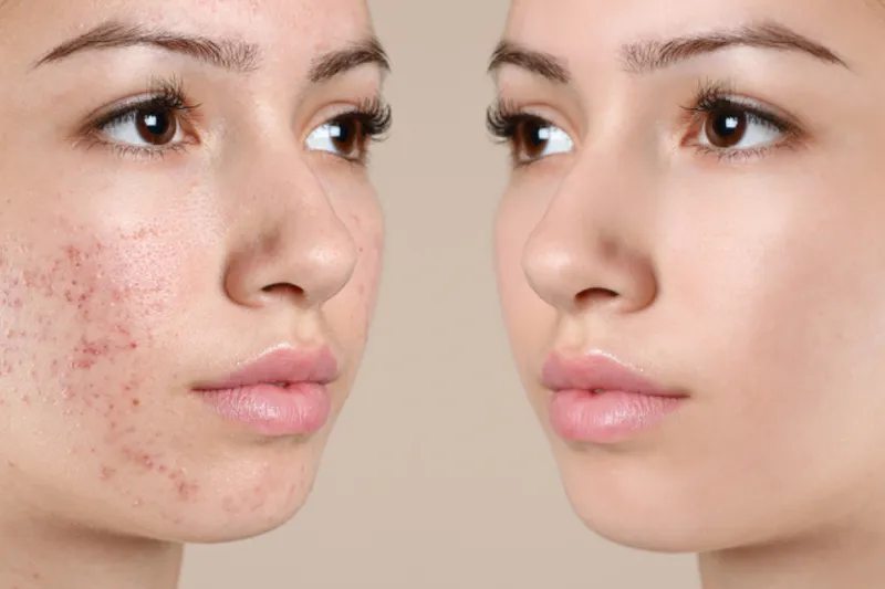 Anti-Acne Treatments