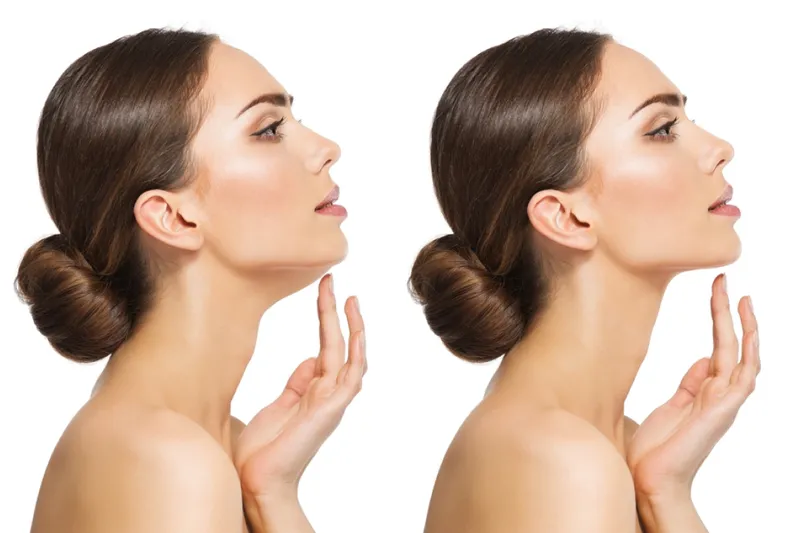 Double Chin Reduction