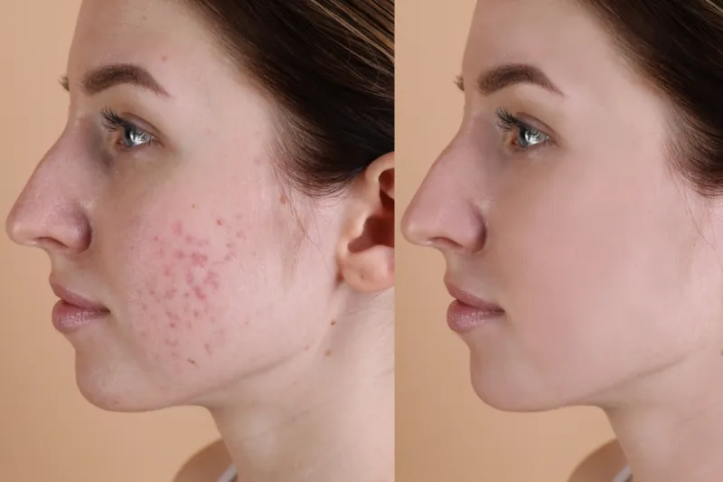 PRP Skin Treatment
